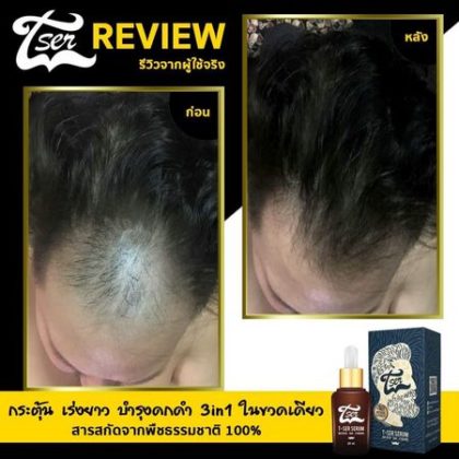 เซรั่มปลูกผม
