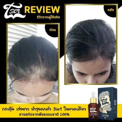 เซรั่มปลูกผม ยี่ห้อไหนดี 2019