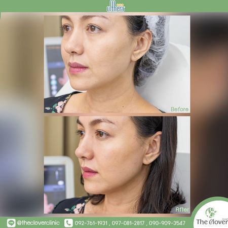 Ulthera 2019 The Clover Clinic
